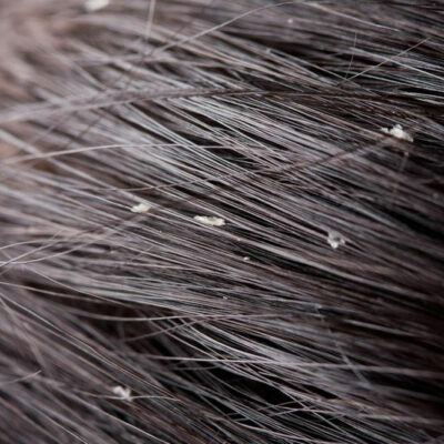 Causes and Types of Dandruff