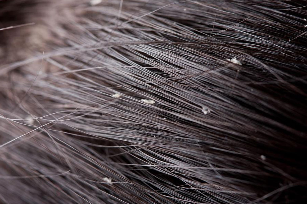 Causes and Types of Dandruff