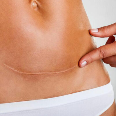 Early Signs of Ovarian Cancer