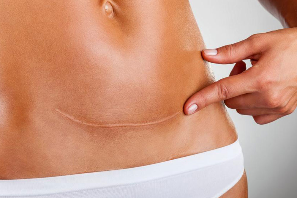 Early Signs of Ovarian Cancer