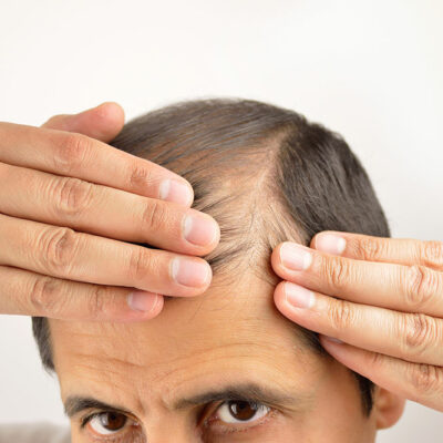 Symptoms and Treatments for Hair Loss
