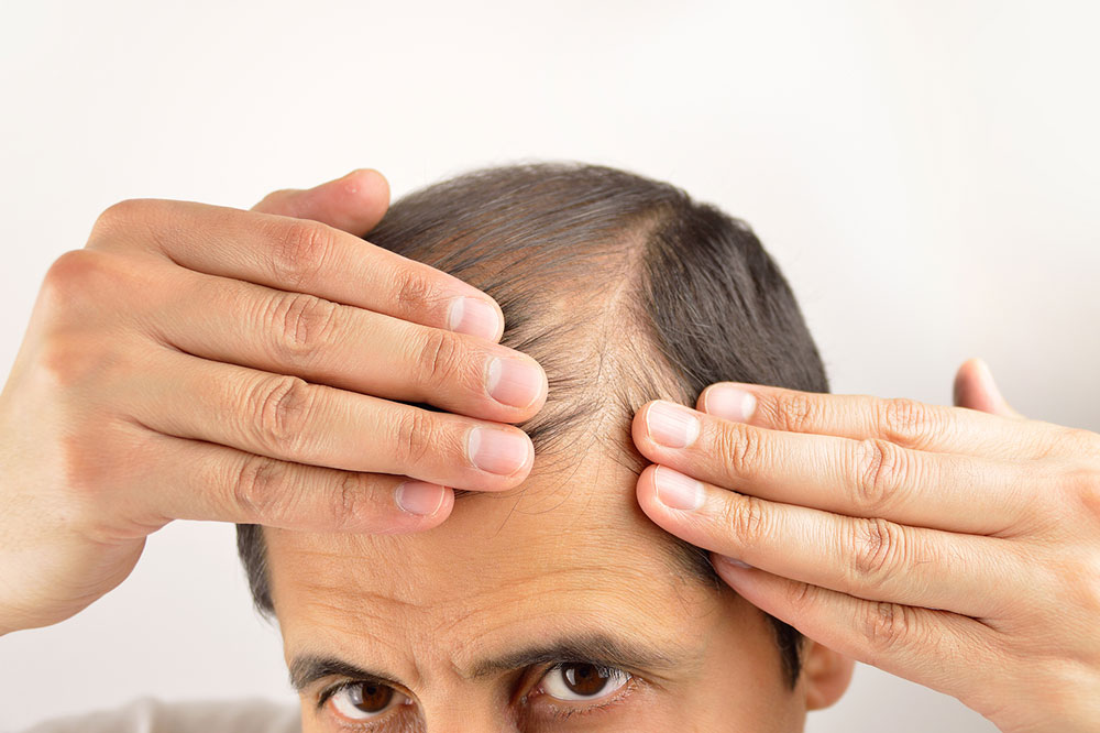 Symptoms and Treatments for Hair Loss