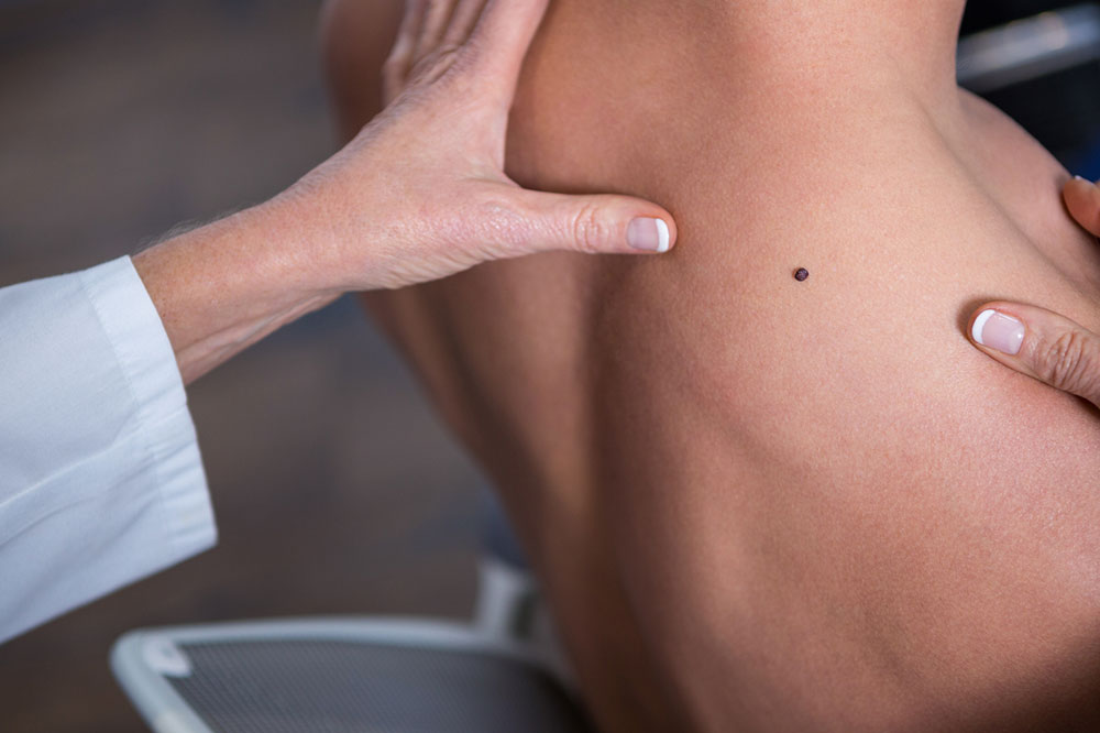 Ways To Prevent And Treat The Signs Of Melanoma